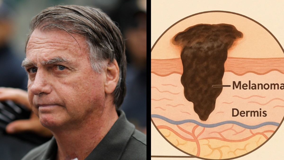 Jair Bolsonaro fue diagnosticado con cáncer de piel  | Especial Discover Milenio