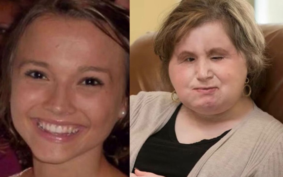 Katie Stubblefield, la paciente más joven de EE. UU. en recibir un trasplante facial.| Especial