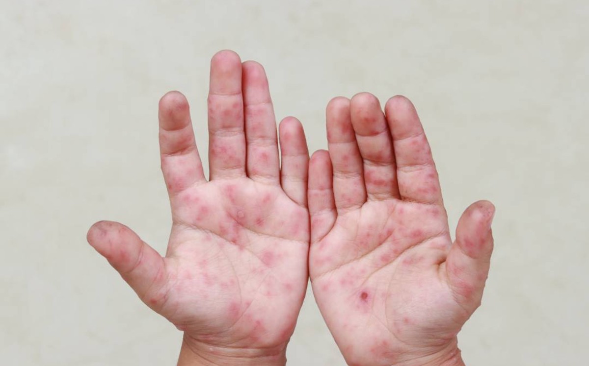 Este virus es  conocido por infectar principalmente el tracto gastrointestinal pero que puede afectar otras partes del cuerpo. | Freepik