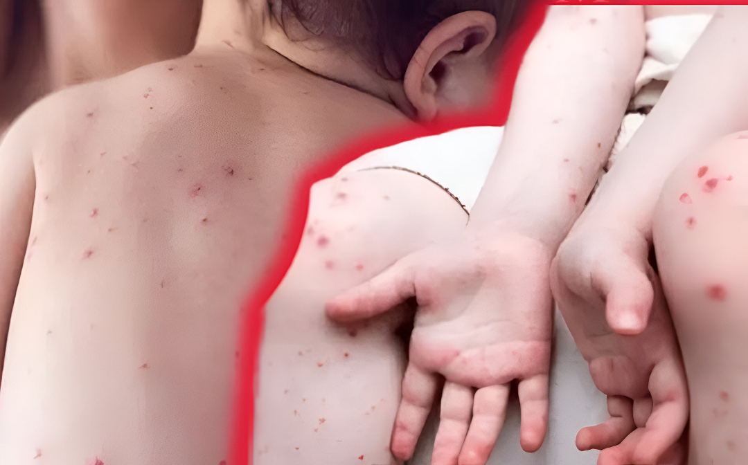 El virus Coxsackie puede causar EMPB (Enfermedad de Manos, Pies y Boca). | Archivo