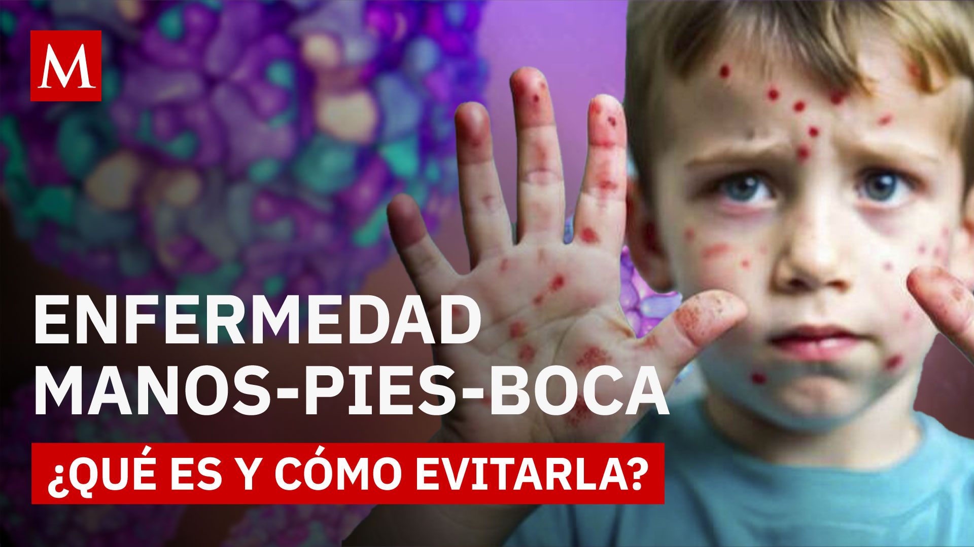 ¿Qué es la EMPB? Todo lo que debes saber sobre la enfermedad que va en aumento