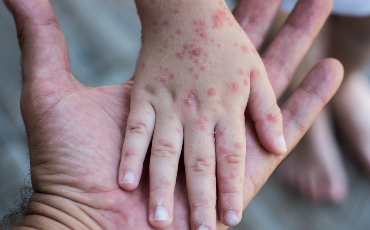 Manos de menor de edad con el virus de Coxsackie