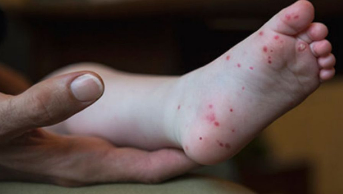 Virus de Coxsackie (CDC)