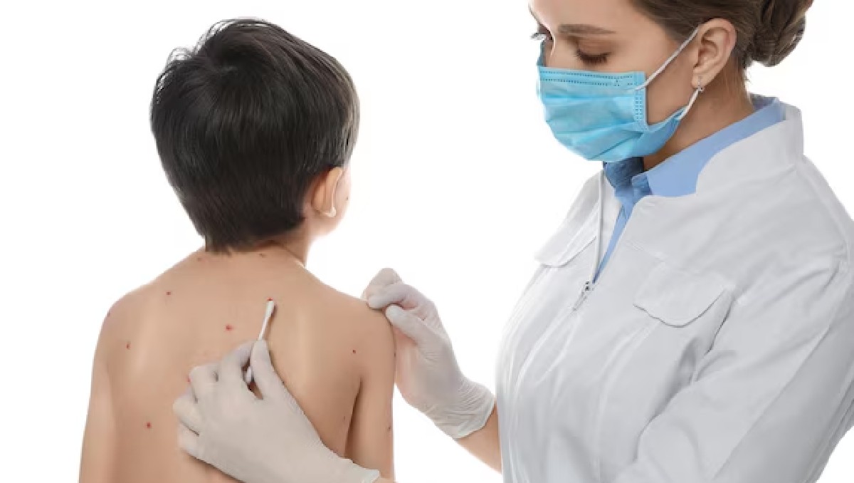 La Secretaría de Salud busca fortalecer la cultura del autocuidado y minimizar el riesgo de transmisión de varicela dentro de la comunidad educativa.