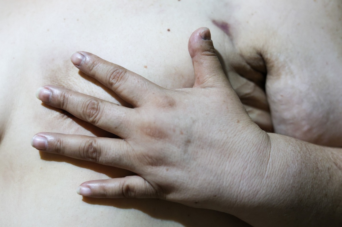 Cáncer de mama. | Verónica Rivera