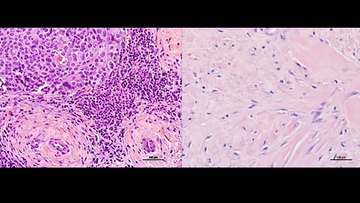 Un nuevo estudio muestra que bloquear la enzima NOS podría hacer más sensible al cáncer de mama metaplásico a tratamientos existentes. ⏐ Shutterstock