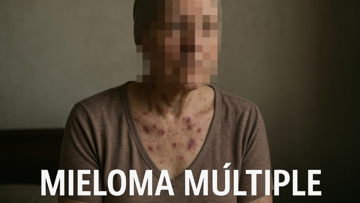 El Mieloma Múltiple es un tipo de cáncer que afecta la sangre | Especial IA Discover