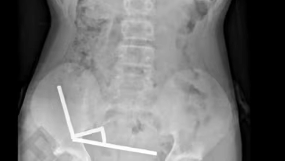 Adolescente traga imanes y pierde parte del intestino. | FOTO: New Zealand Medical Journal