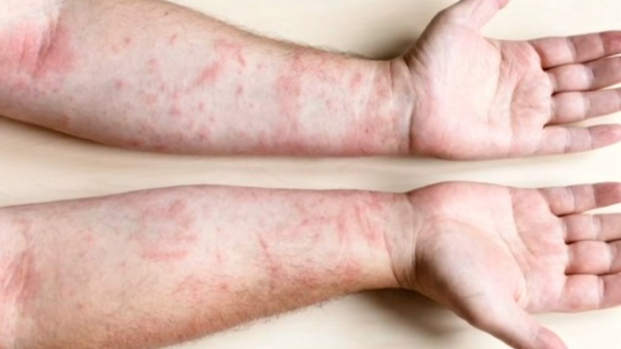 Bebé de Guerrero muere en Jalisco por sarampión, al parecer sin vacunar