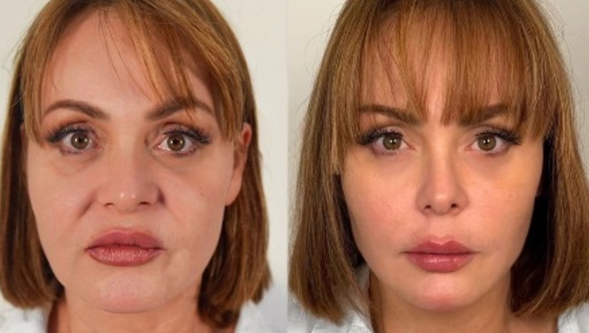 Gaby Spanic antes y después de su tratamiento estético. | FOTO: Gaby Spanic