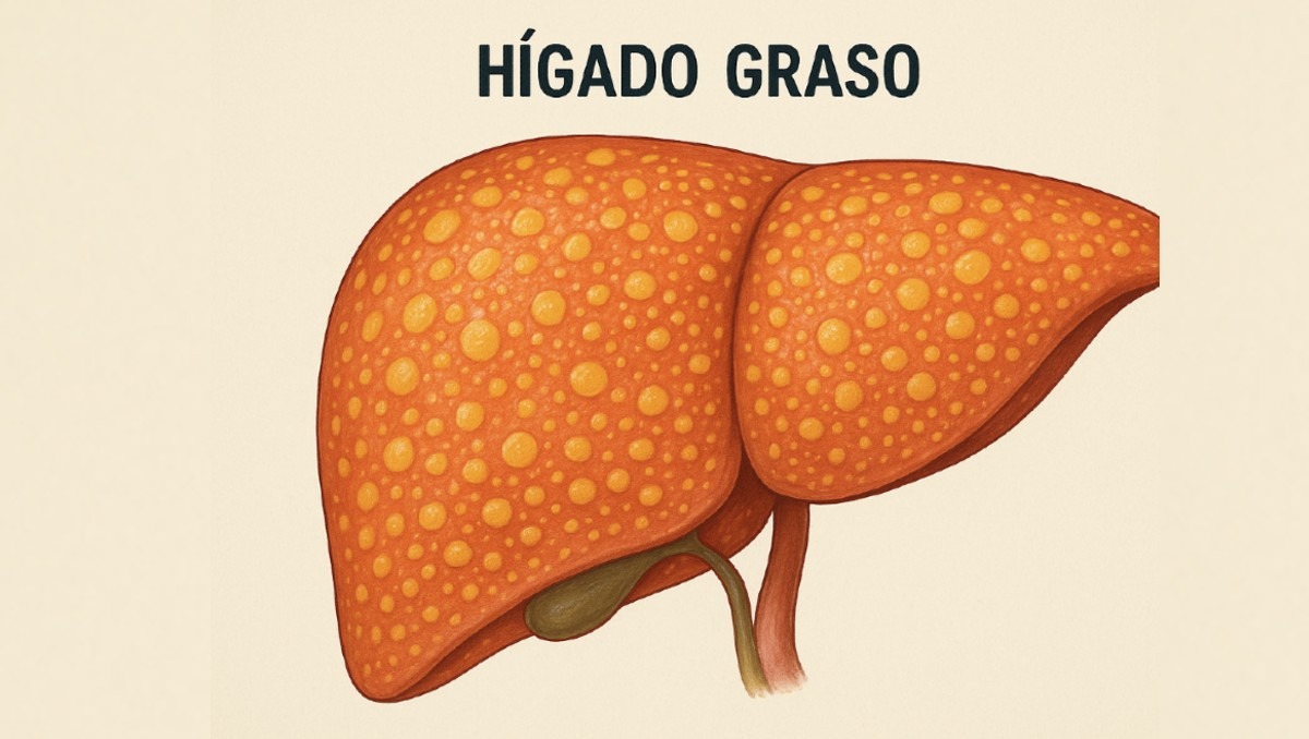 No todo está perdido. ¿Hasta cuándo puedes revertir las consecuencias del hígado graso antes de que sea tarde?