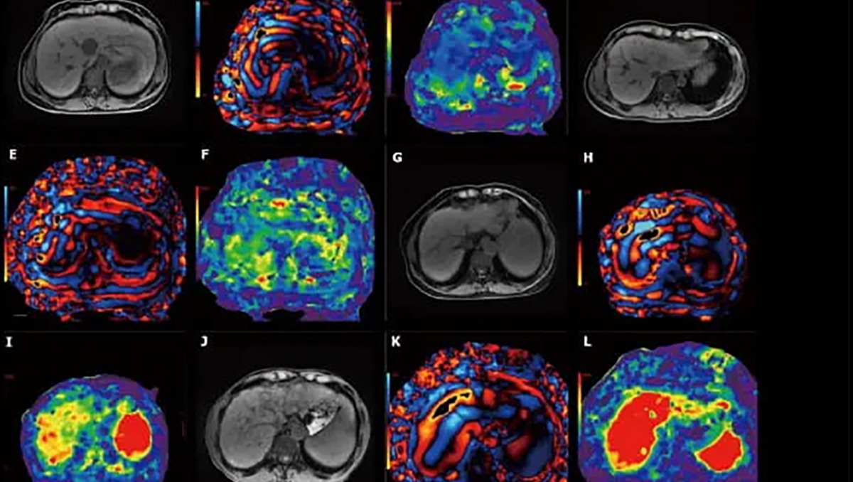 10 minutos para salvar tu hígado: conoce el examen que podría cambiar la forma de detectar la fibrosis hepática