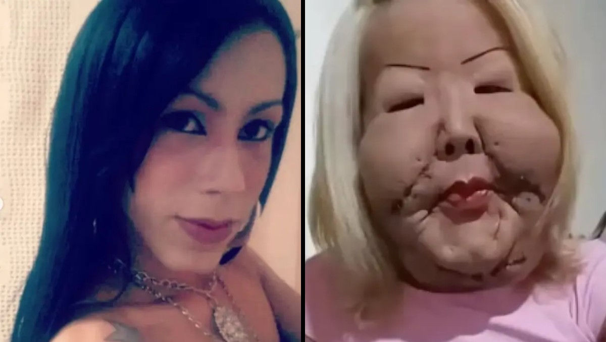 Influencer desfiguró su rostro tras una cirugía estética clandestina