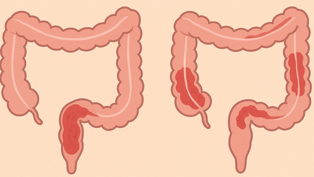 La Colitis Ulcerosa y la Enfermedad de Crohn ya afecta más a los jóvenes | Especial Discover Milenio