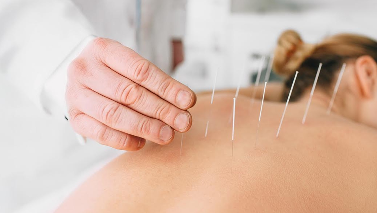 Todo lo que querías saber sobre la acupuntura (Shutterstock)