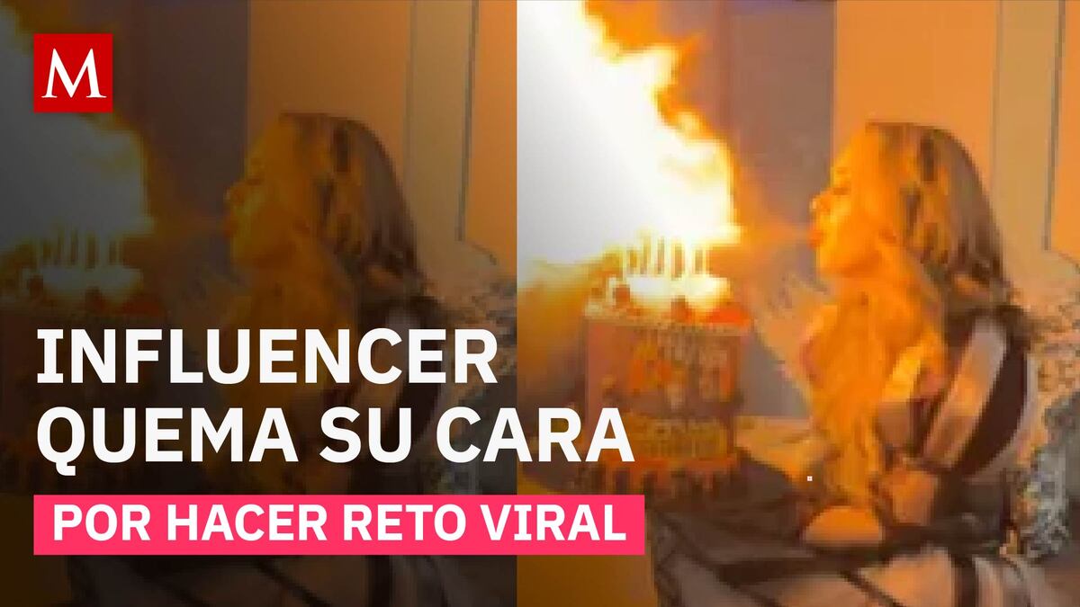 Reto viral deja a influencer con quemaduras de primer y segundo grado en el rostro