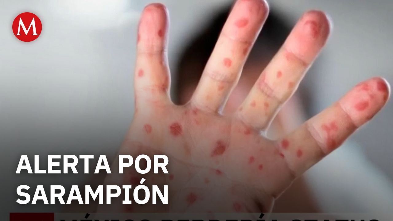 México enfrenta repunte de sarampión y Jalisco activa medidas de contención