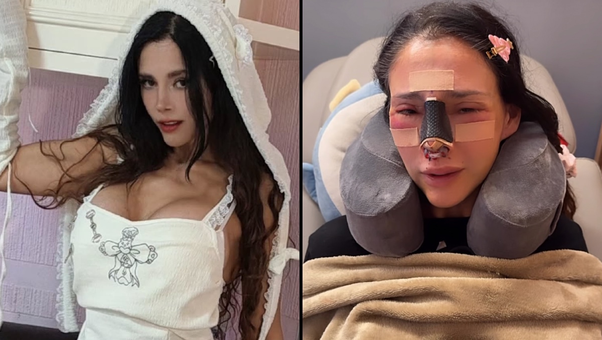 Dorismar, la famosa modelo que terminó con la nariz destruida por una mala praxis | ESPECIAL