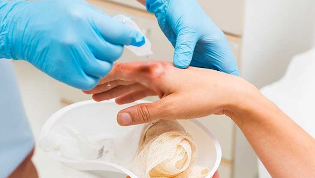 Guanajuato incrementa quemaduras durante diciembre | Especial