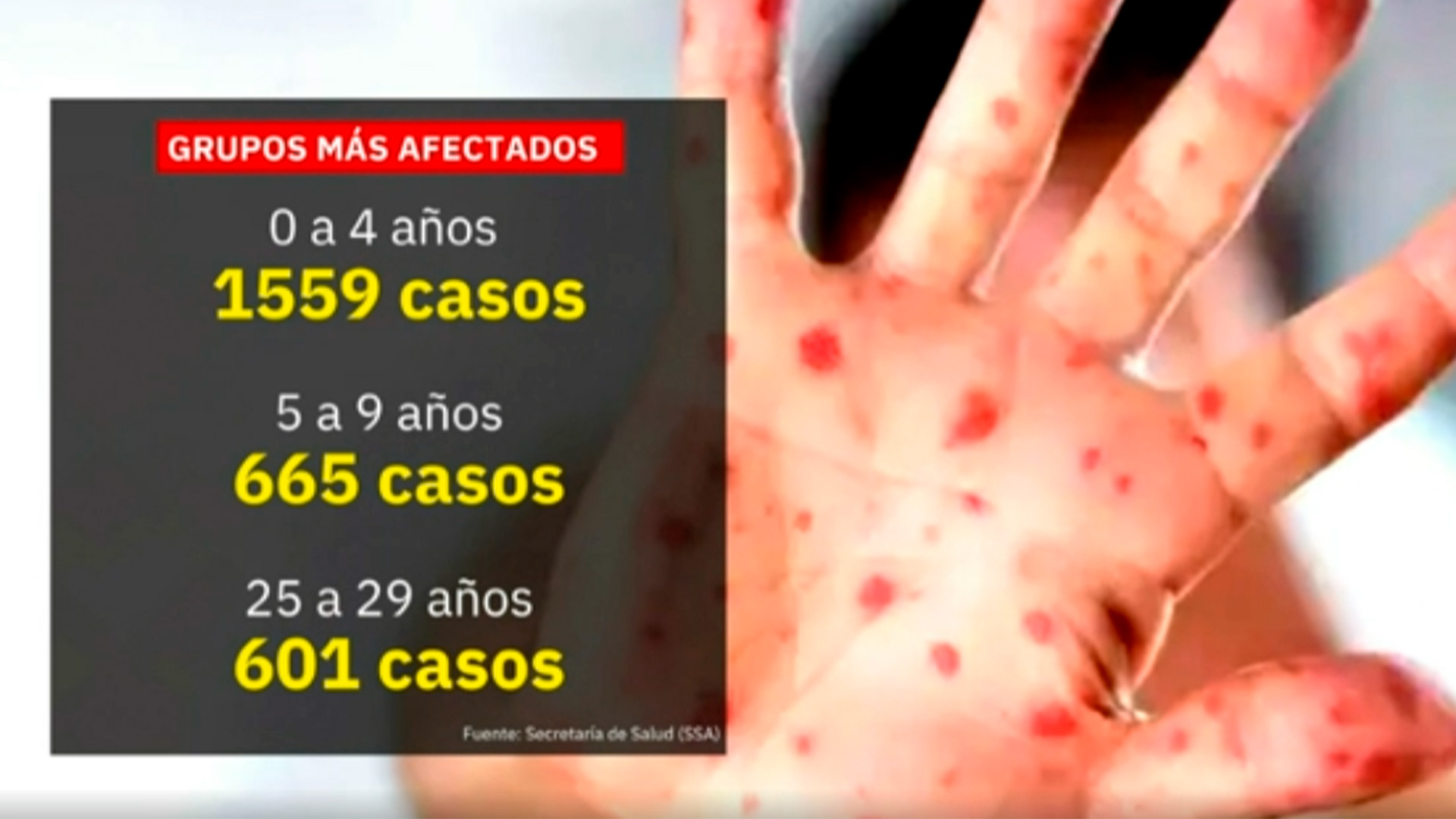 Secretaría de Salud publica reporte de casos de sarampión en México