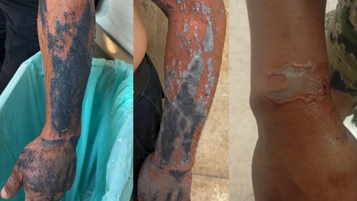 Hombre ataca con ácido a elementos de seguridad en Villa de Álvarez, Colima