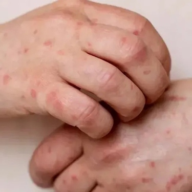 Con el primer caso de sarampión en Puebla, ya no hay entidades que estén libres de este padecimiento en sus territorios.