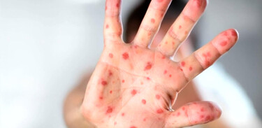 Brote de sarampión en Chihuahua suma 400 casos en 24 horas pese a llamado a vacunarse