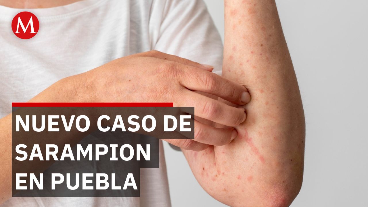 Confirman segundo caso de sarampión en Puebla tras casi 30 años