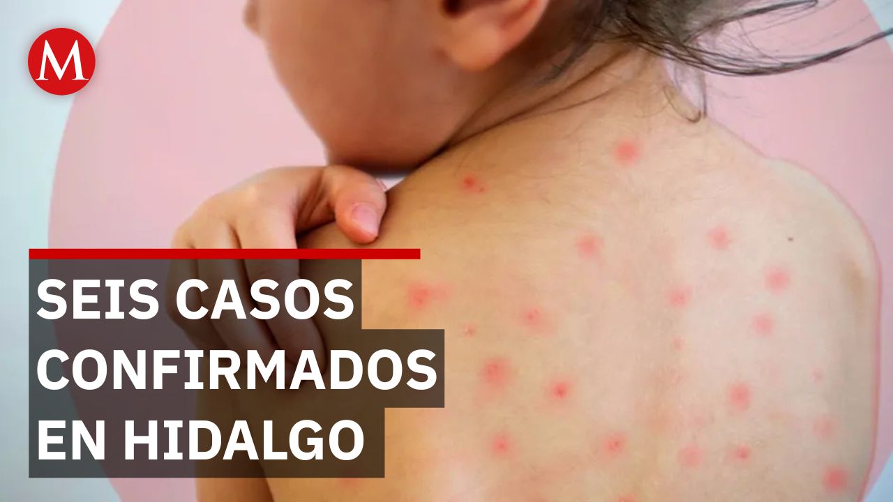 Salud Hidalgo confirma seis contagios de sarampión y refuerza estrategia de vacunación
