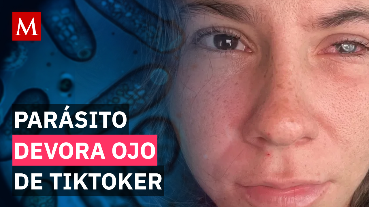 El caso de la tiktoker que puede perder un ojo a causa de un parásito