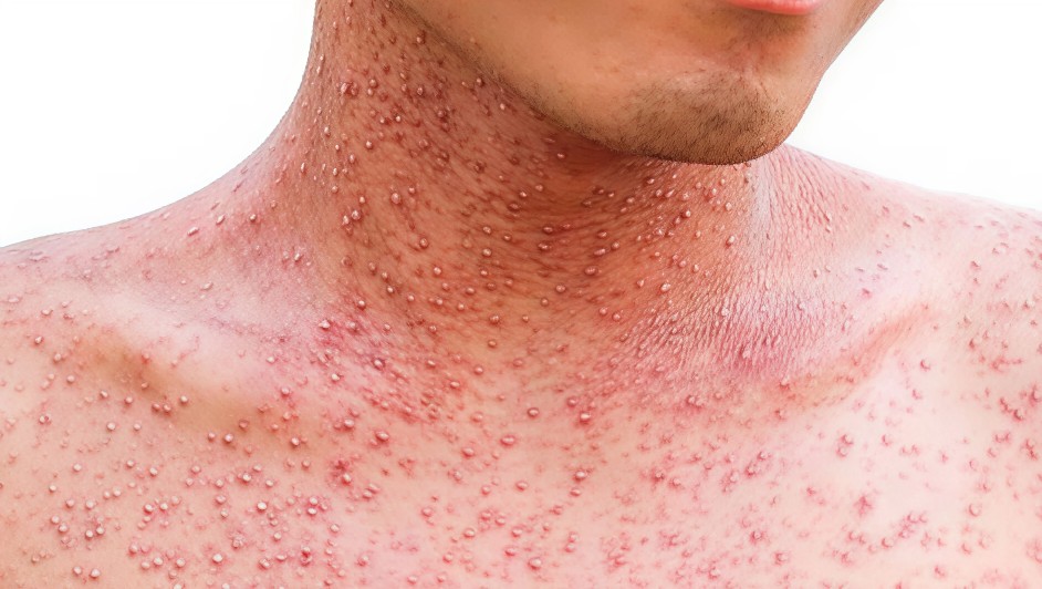 Sarampión mantiene transmisión activa en México: Jalisco y Chiapas repuntan en 2026 | Archivo