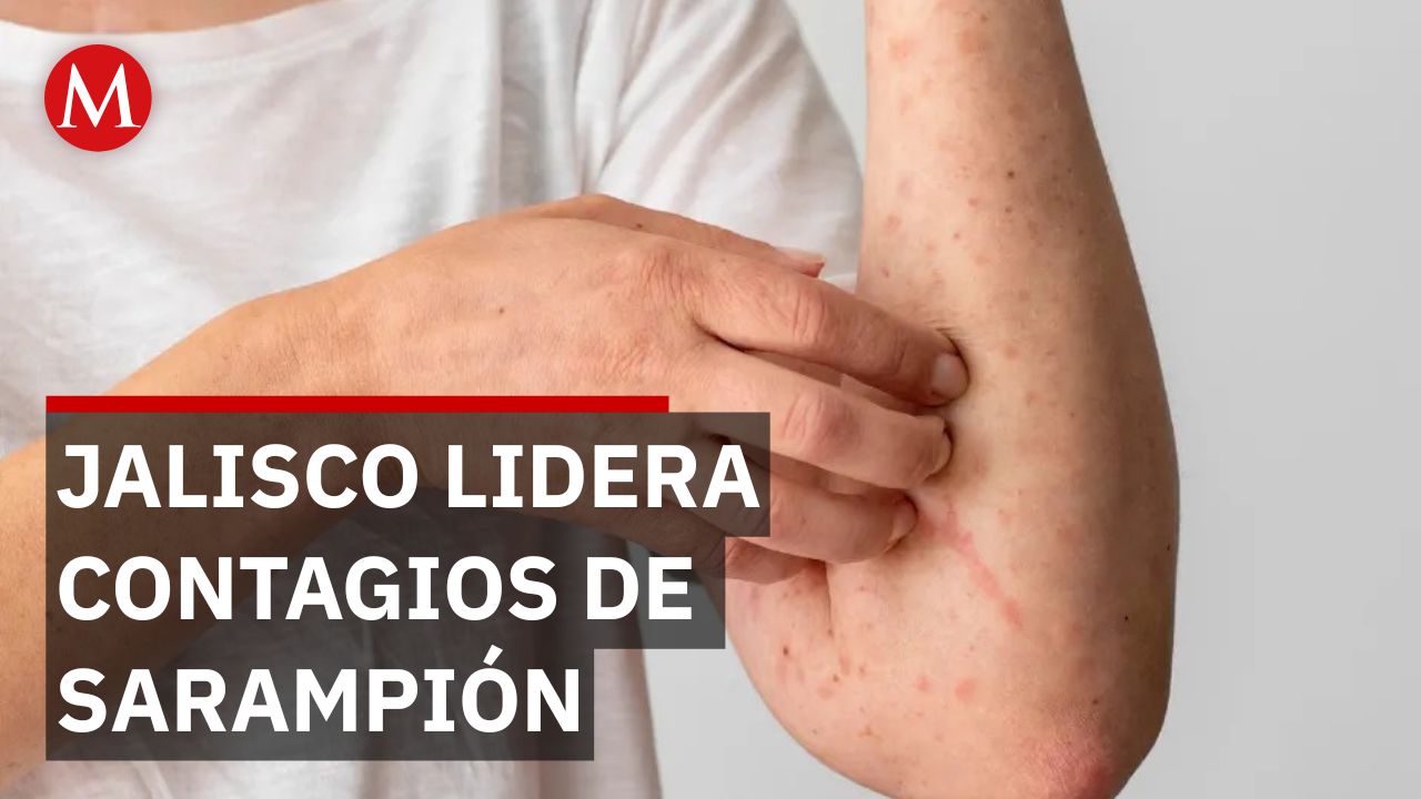 Repunte de sarampión en Jalisco eleva alarma epidemiológica