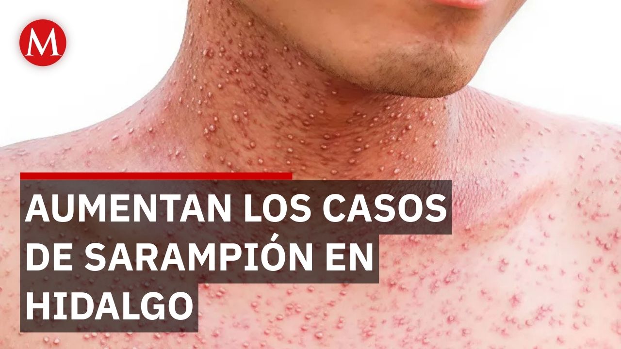 En Hidalgo, aumenta a 7 los casos confirmados de sarampión