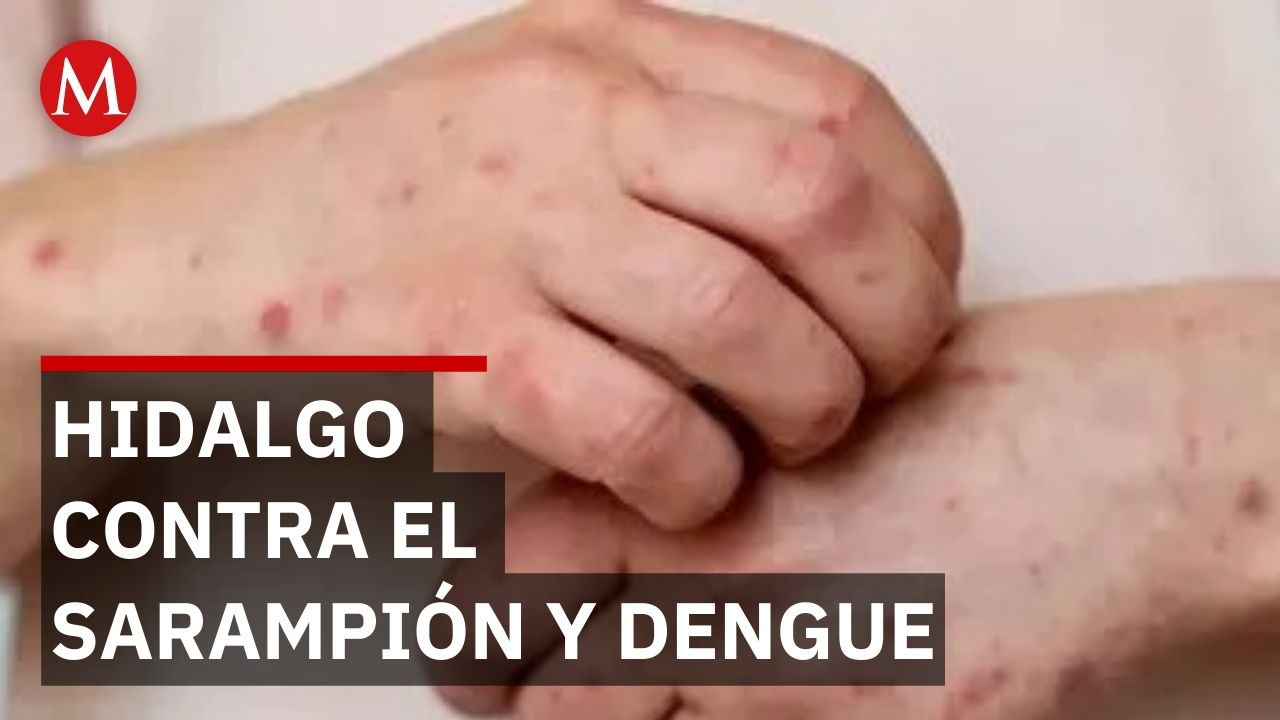 Huasteca Hidalguense en alerta: Combaten brotes de sarampión y dengue