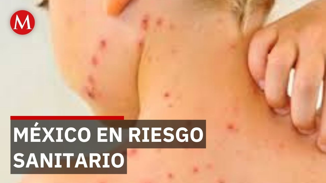 ¿México perderá el estatus libre de sarampión? El Dr. Macías responde