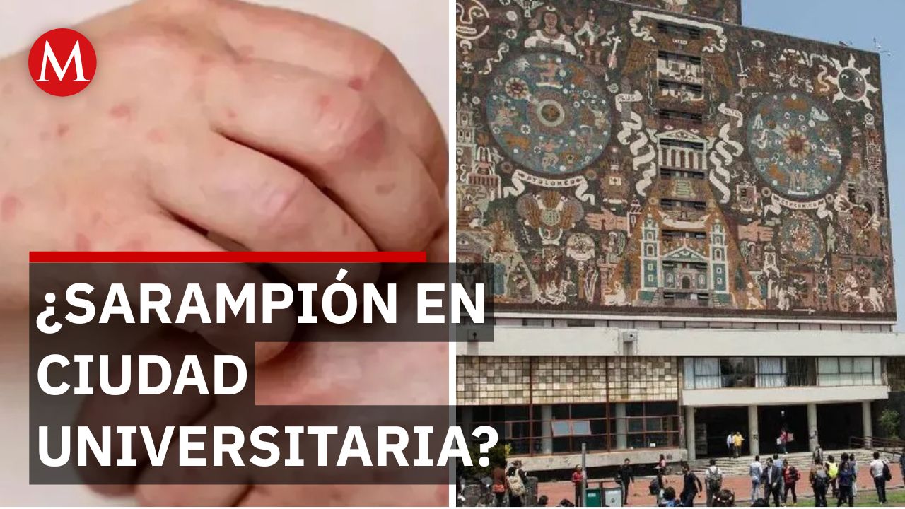 ¿Regresa el sarampión? Alarma en la Facultad de Medicina por caso sospechoso