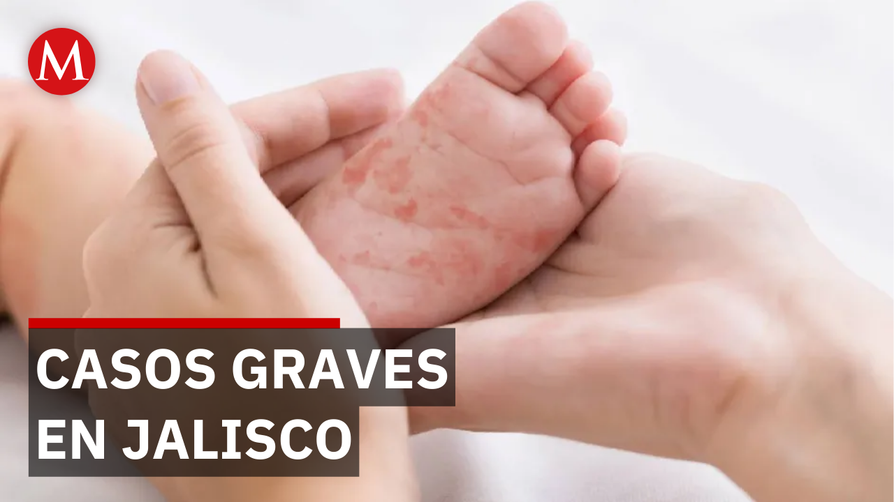 Reportan 28 casos graves de personas hospitalizadas por sarampión en Jalisco