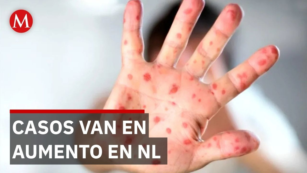 Nuevo León suma tres casos de sarampión en lo que va del año