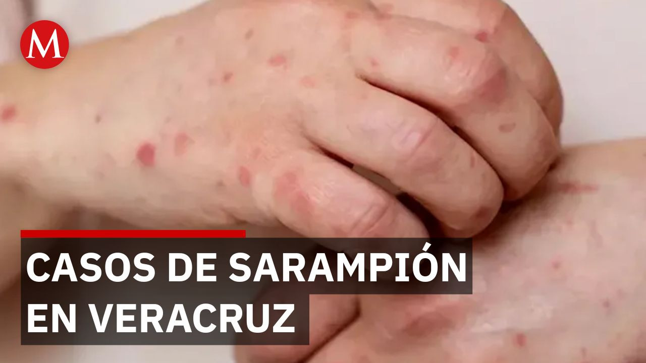 En Veracruz, se han acumulado 13 casos de sarampión