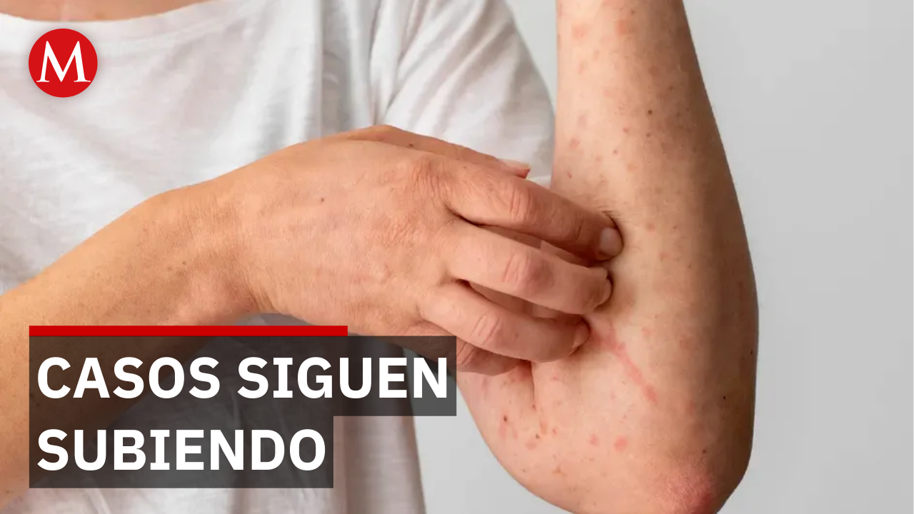 ¿Cómo prevenir el sarampión? Alerta de la OPS y dosis de refuerzo