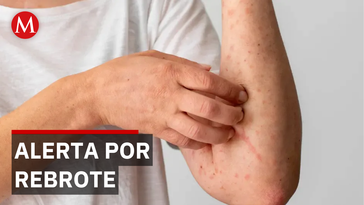 ¿Adiós a la erradicación? El virus del sarampión pone en jaque la salud pública