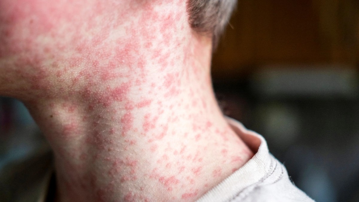 Sarampión en León: detectan posible caso; activan cerco sanitario | Especial