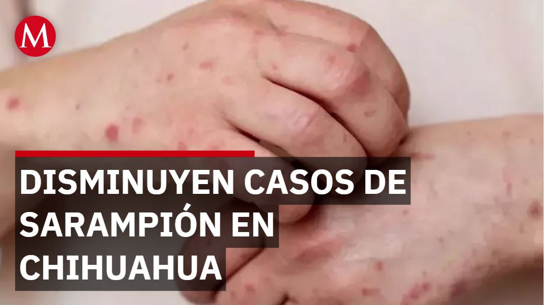 Vacunación reduce casos de sarampión en Chihuahua