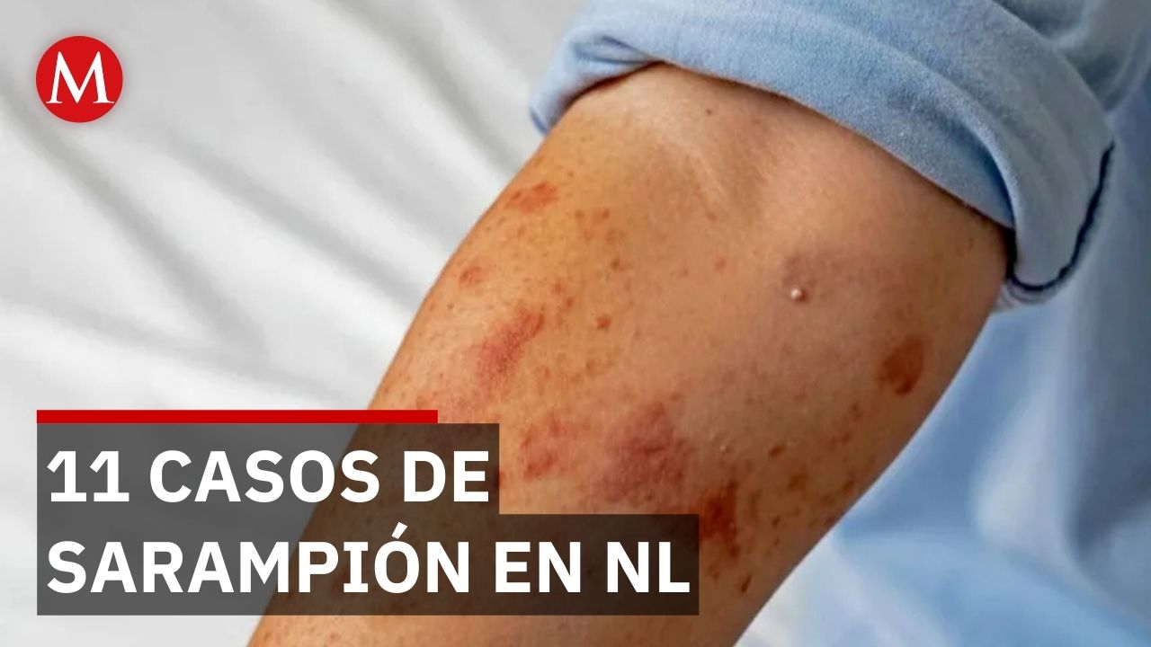 Salud de Nuevo León reporta 11 contagios de sarampión