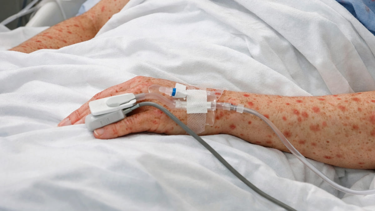 ¿El sarampión mata? Éstas son las principales complicaciones de la enfermedad viral que podrían causar muerte