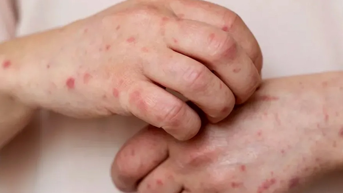 Guanajuato registra cinco casos de sarampión en febrero tras confirmar dos nuevos contagios en León.