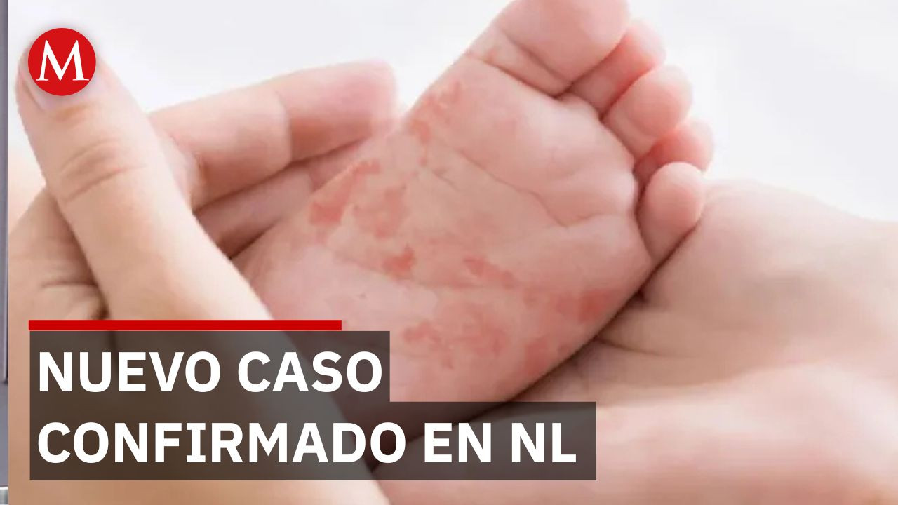 Nuevo León registra 36 casos de sarampión tras confirmar nuevo contagio