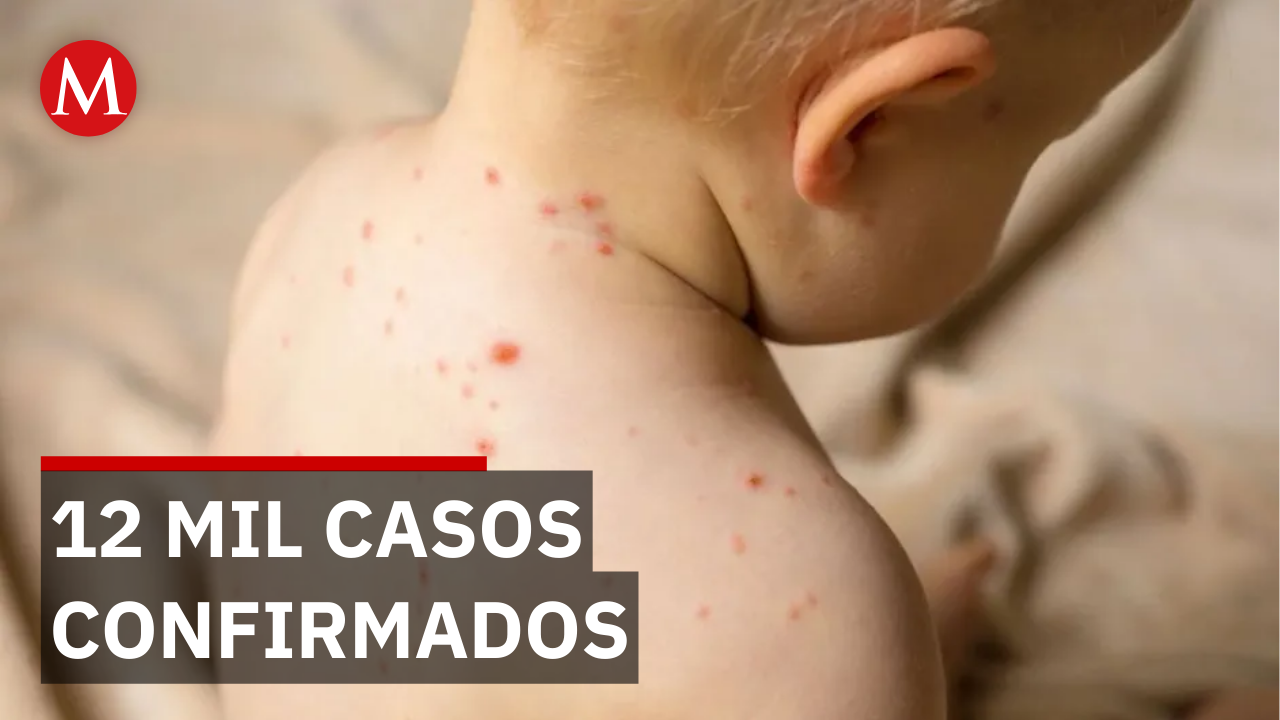 ¿Estamos protegidos? El avance imparable del sarampión en varios estados