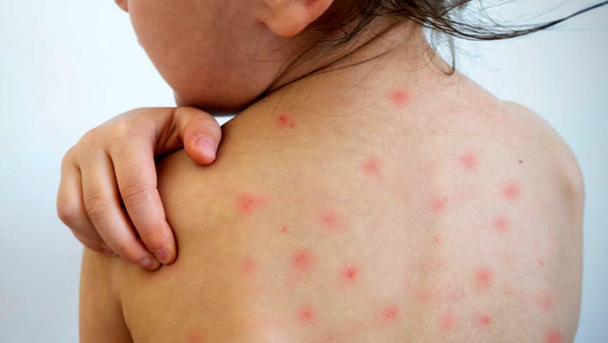 Guanajuato mantiene 10 casos confirmados de sarampión y 6 sospechosos en estudio.