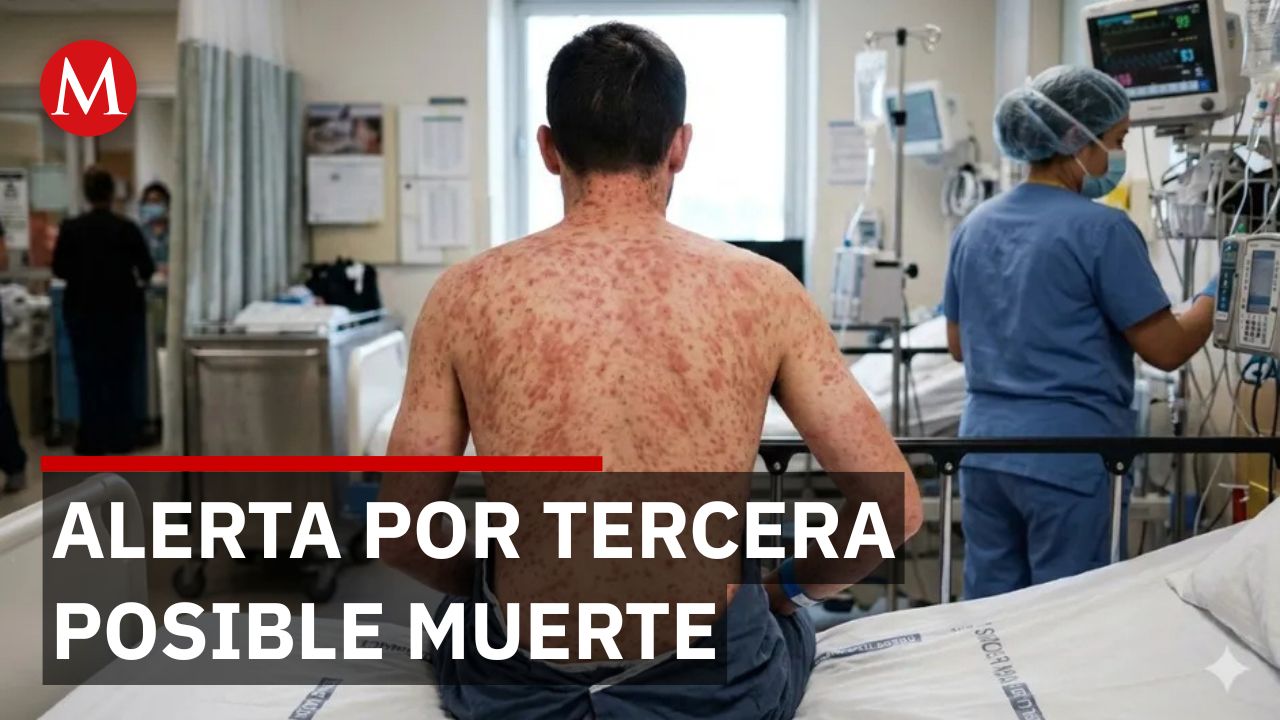 Segunda muerte por sarampión en CdMx y 576 casos confirmados